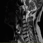 吹田市江坂の腰痛・ヘルニア専門のカイロプラクティック院の症例頚椎ヘルニア