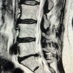 MRI