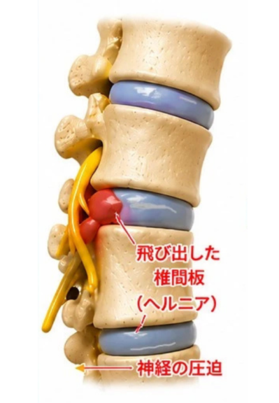 hernia-decompression.1