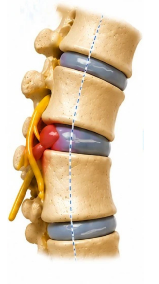 hernia-decompression.2