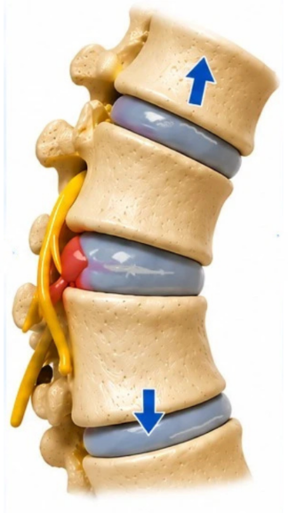 hernia-decompression.3