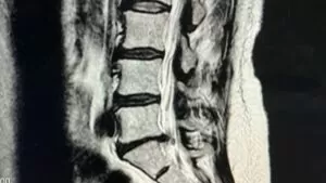 MRI